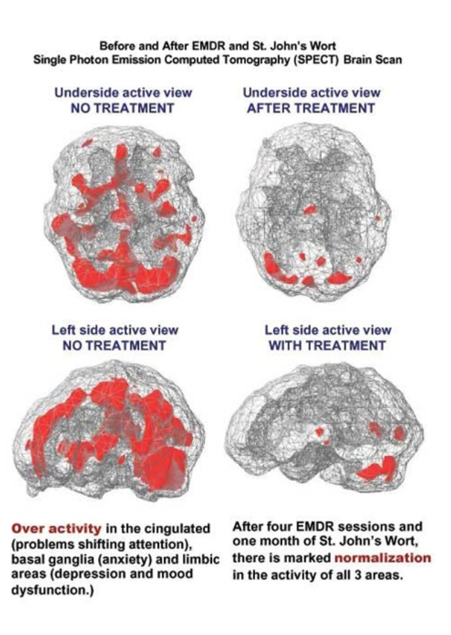 EMDR brain scan — brain activity normalizing before and after EMDR sessions
